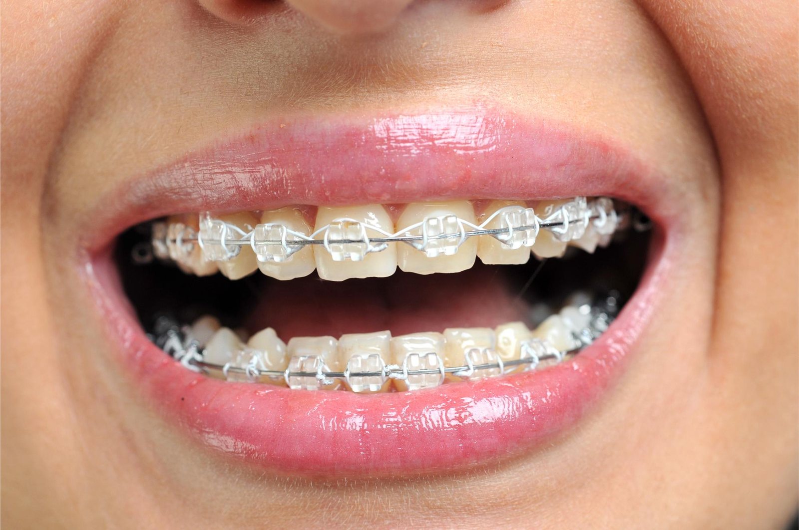 Close-up of ceramic braces on upper teeth