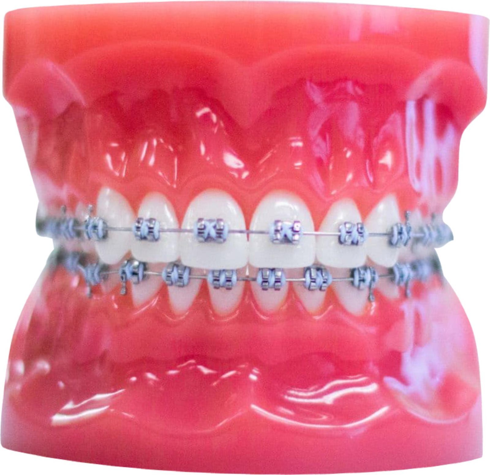 Metal braces with brackets and archwire on a dental model