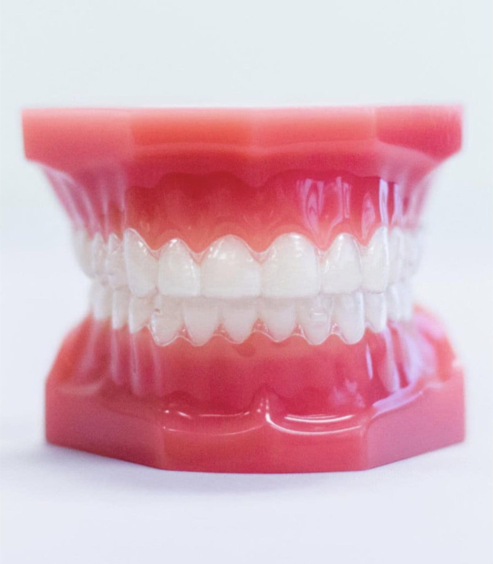 Clear removable retainer on a dental model