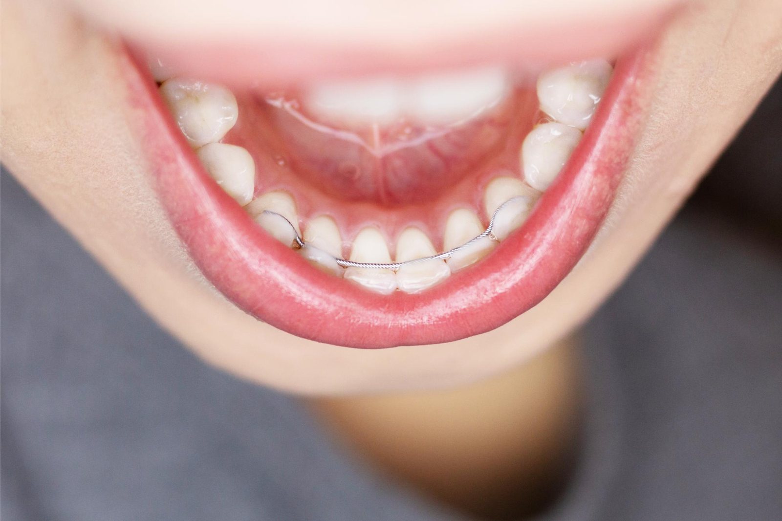 Fixed bonded retainer behind the lower front teeth