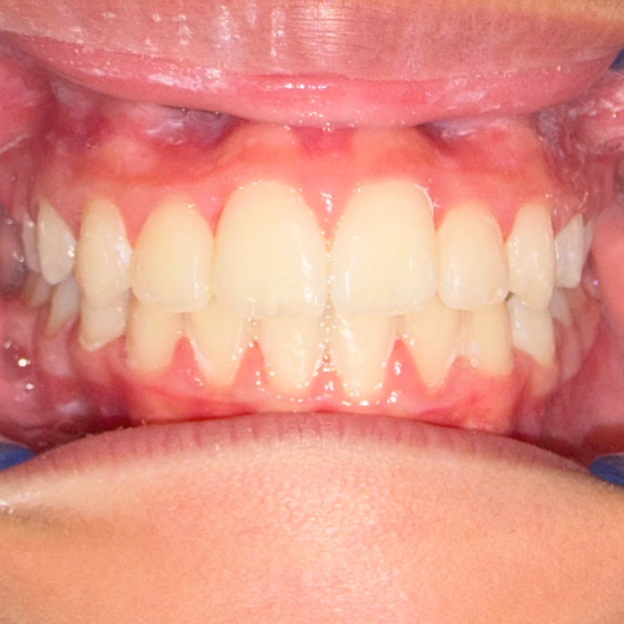 Case One after teeth photo