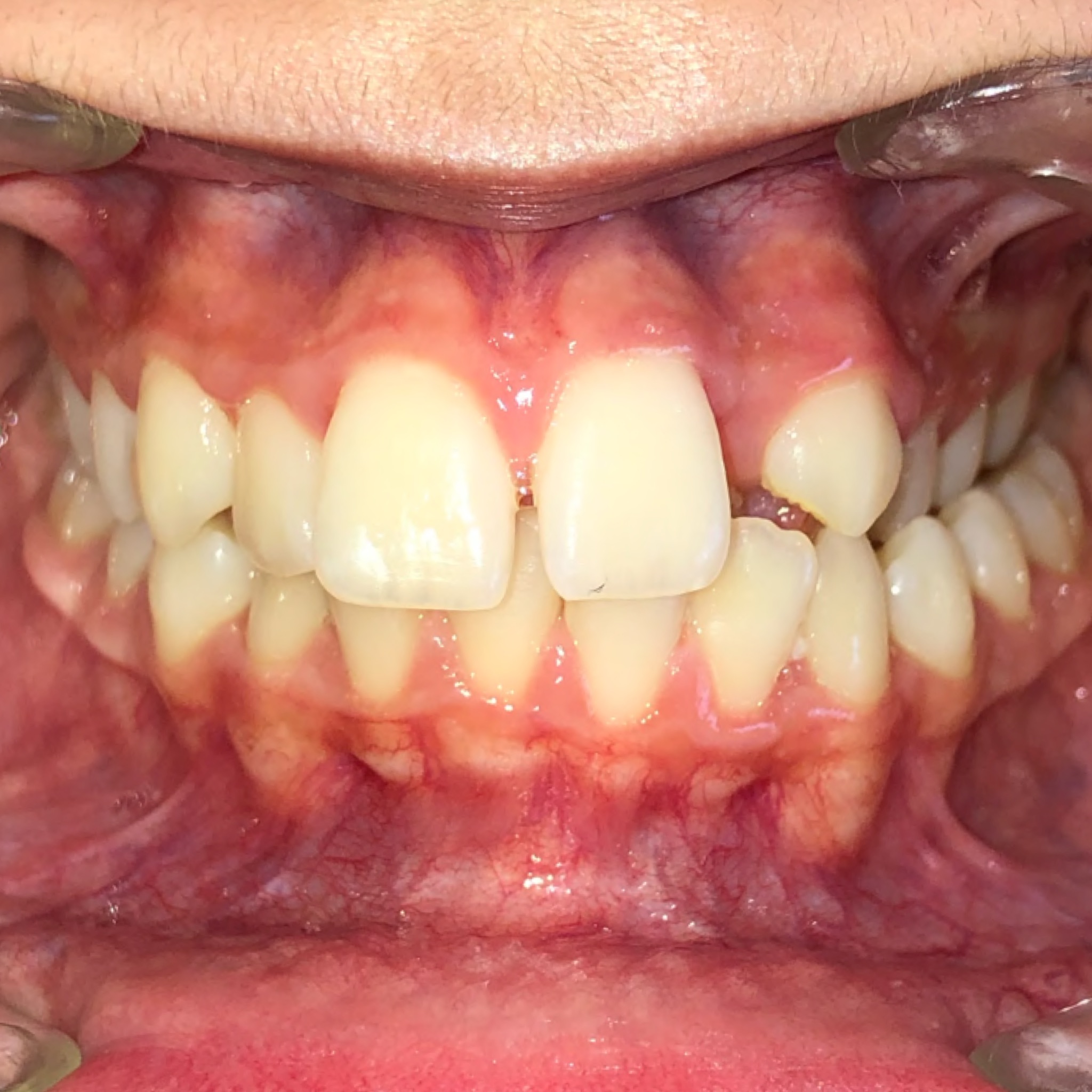 Case One before teeth photo