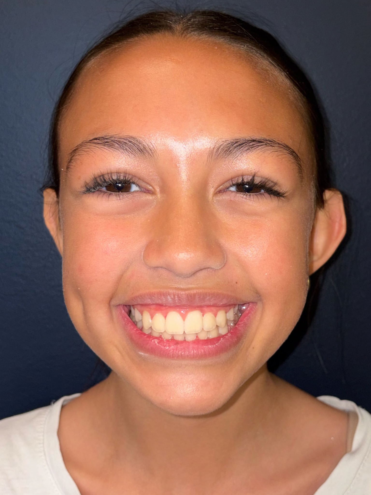 Case One after smile photo