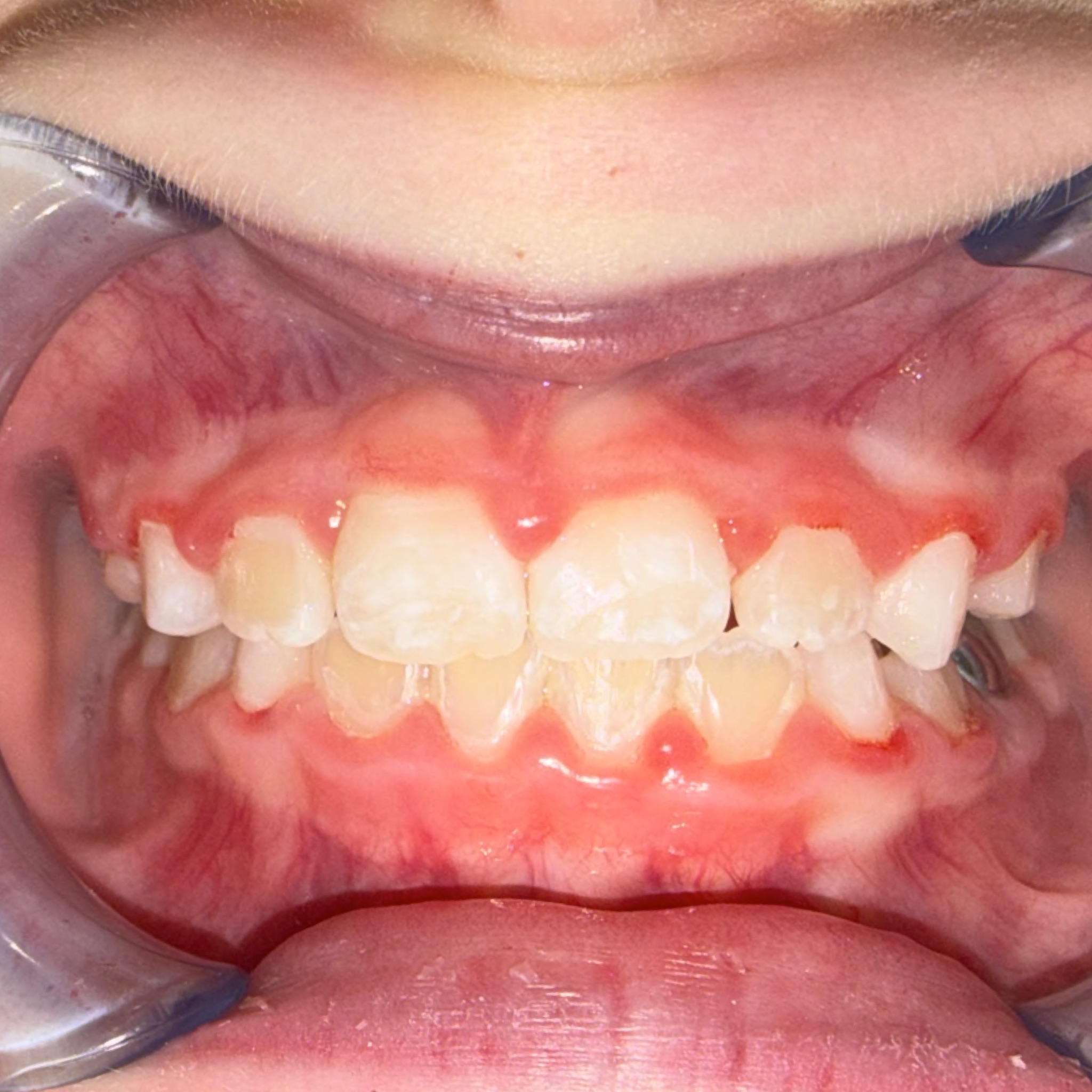 Case Two after teeth photo