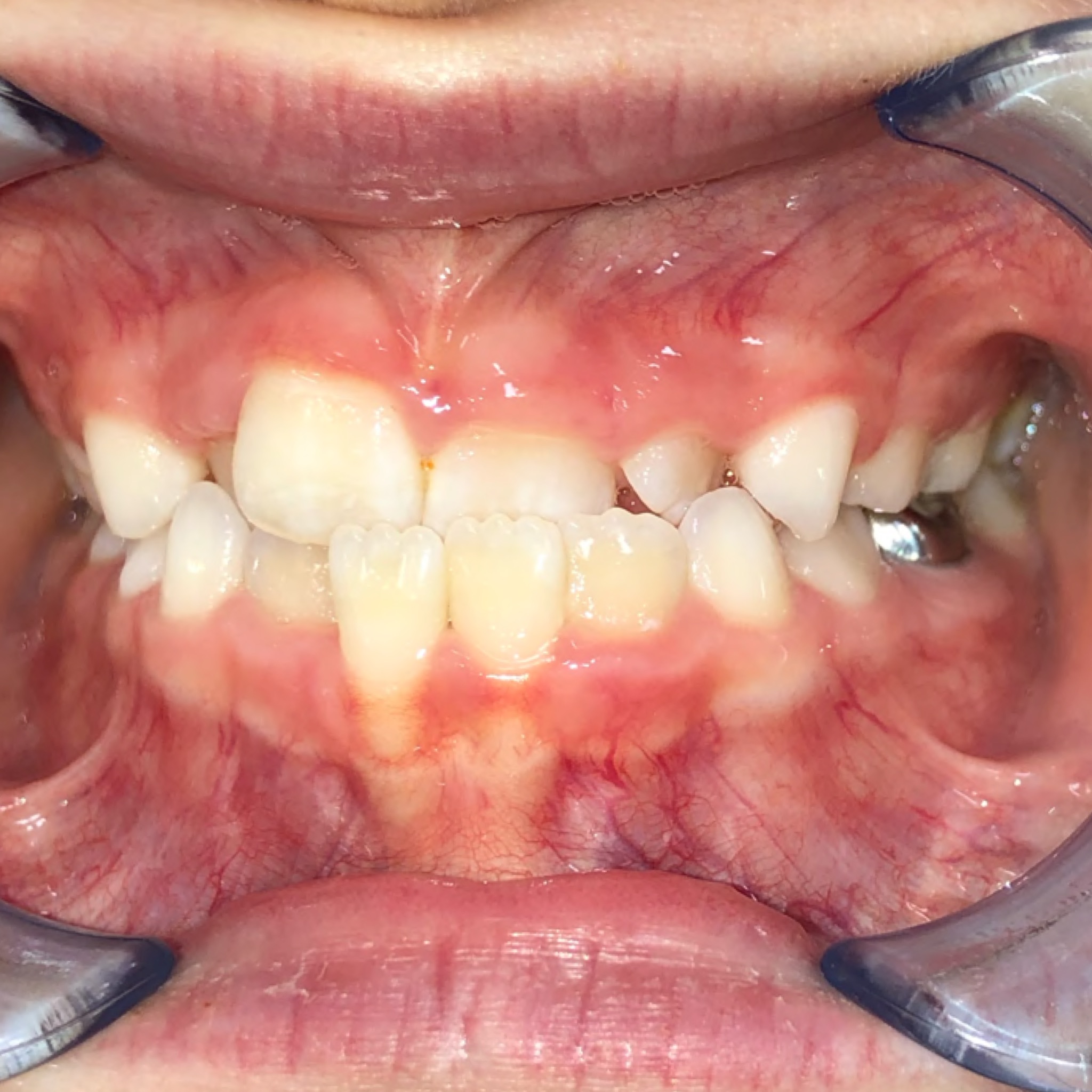 Case Two before teeth photo