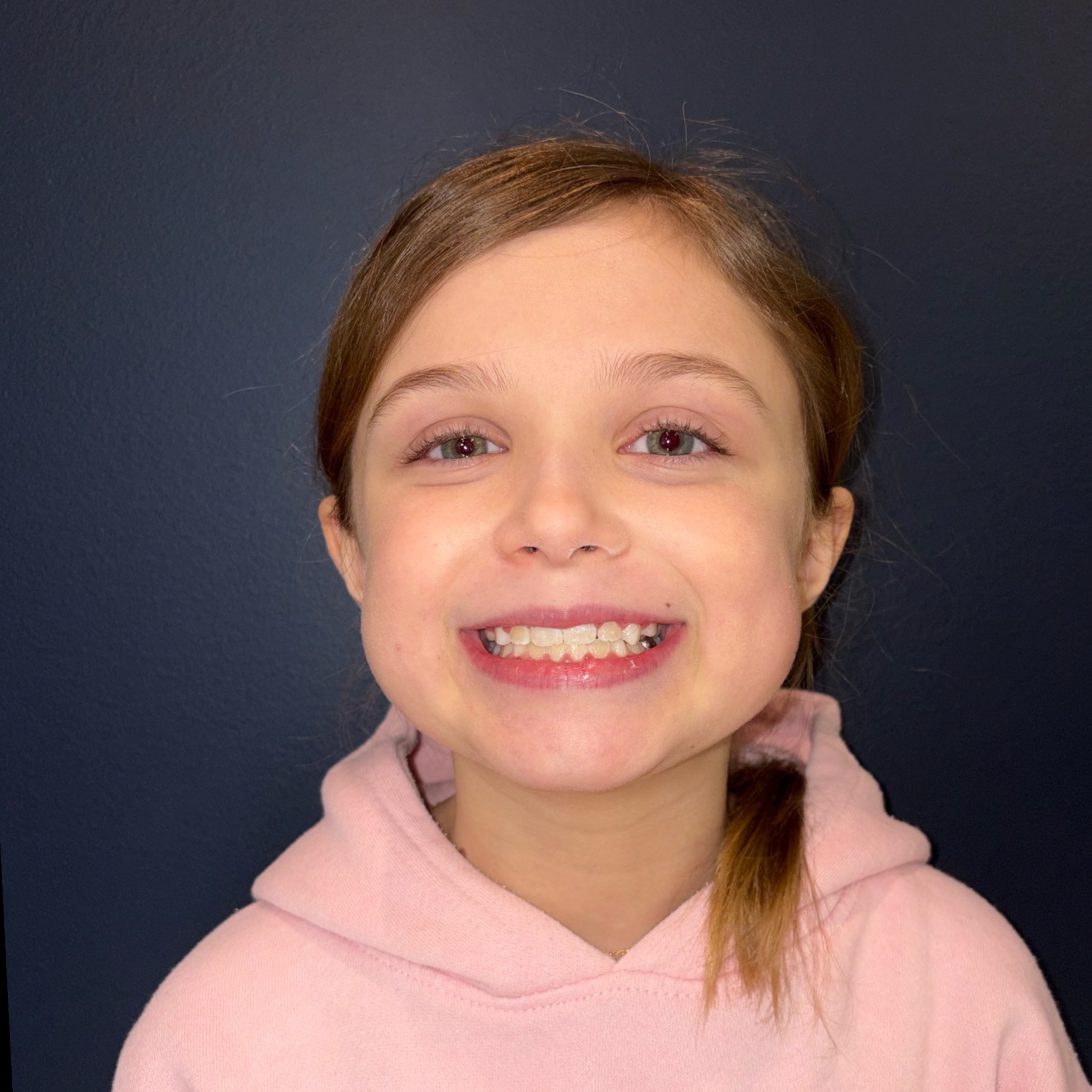 Case Two after smile photo