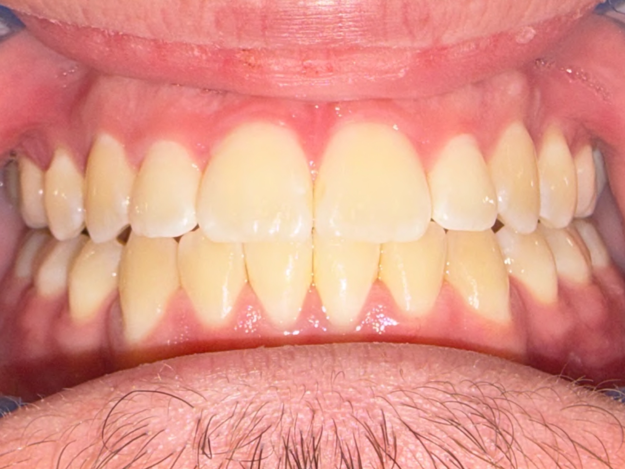 Case Three after teeth photo