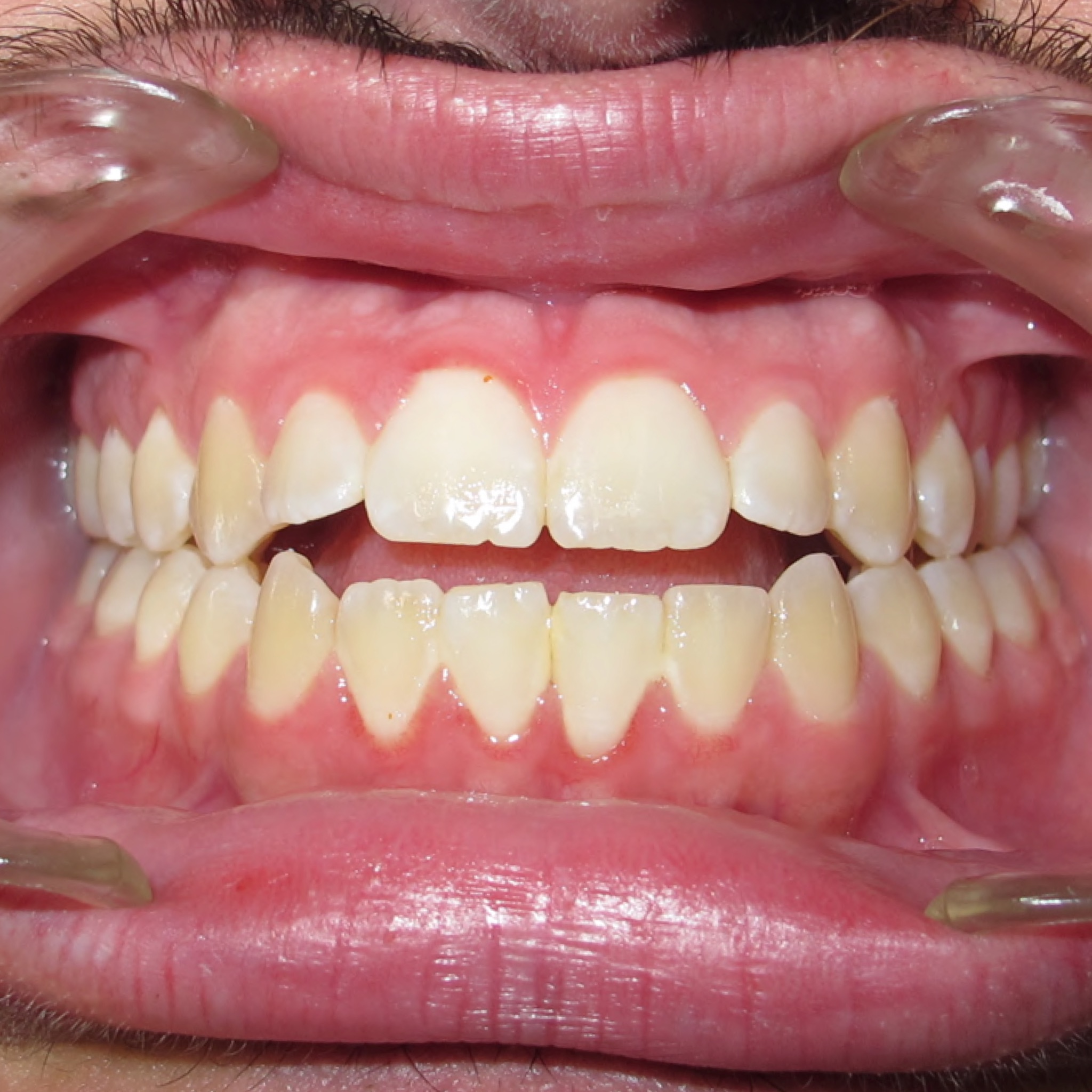 Case Three before teeth photo