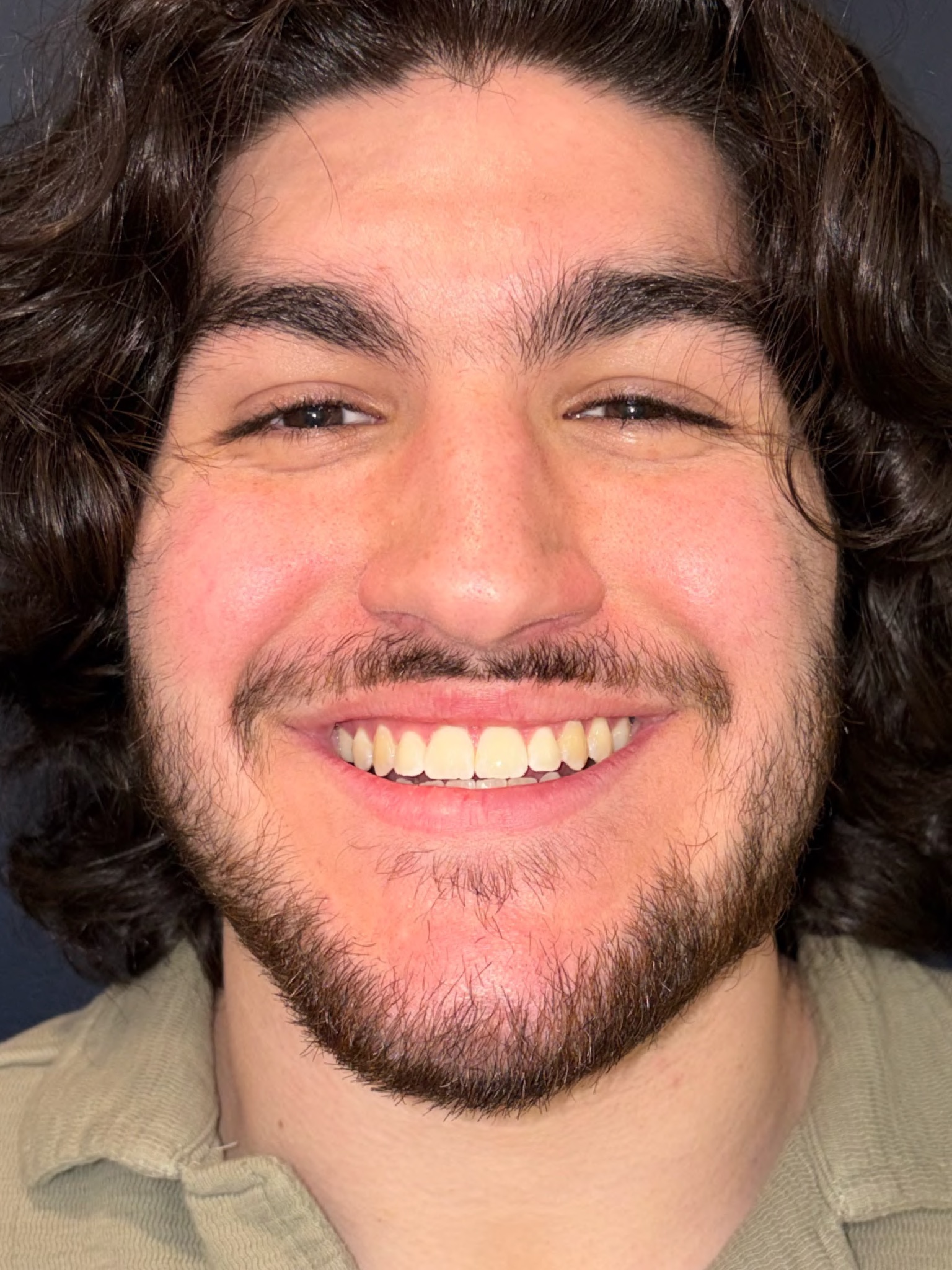 Case Three after smile photo