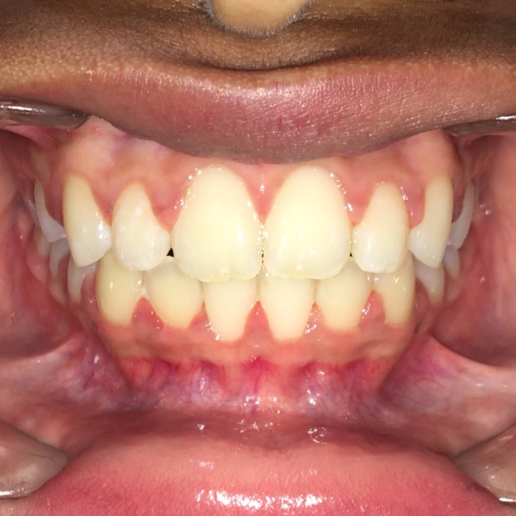 Case Four after teeth photo