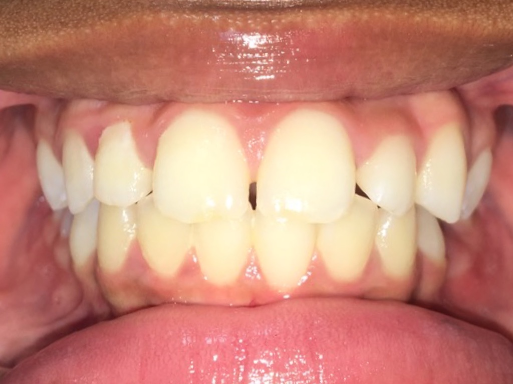 Case Four before teeth photo