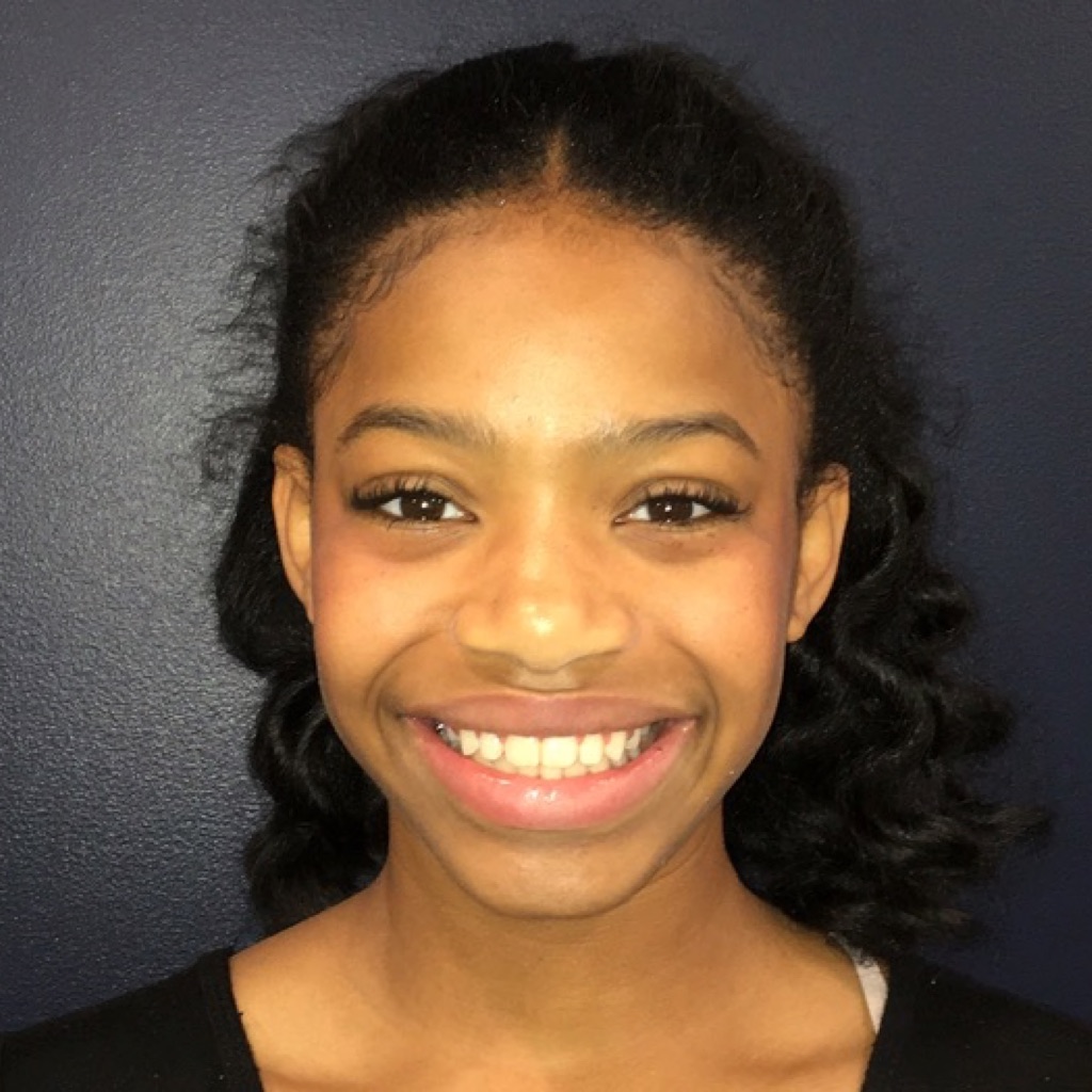 Case Four after smile photo