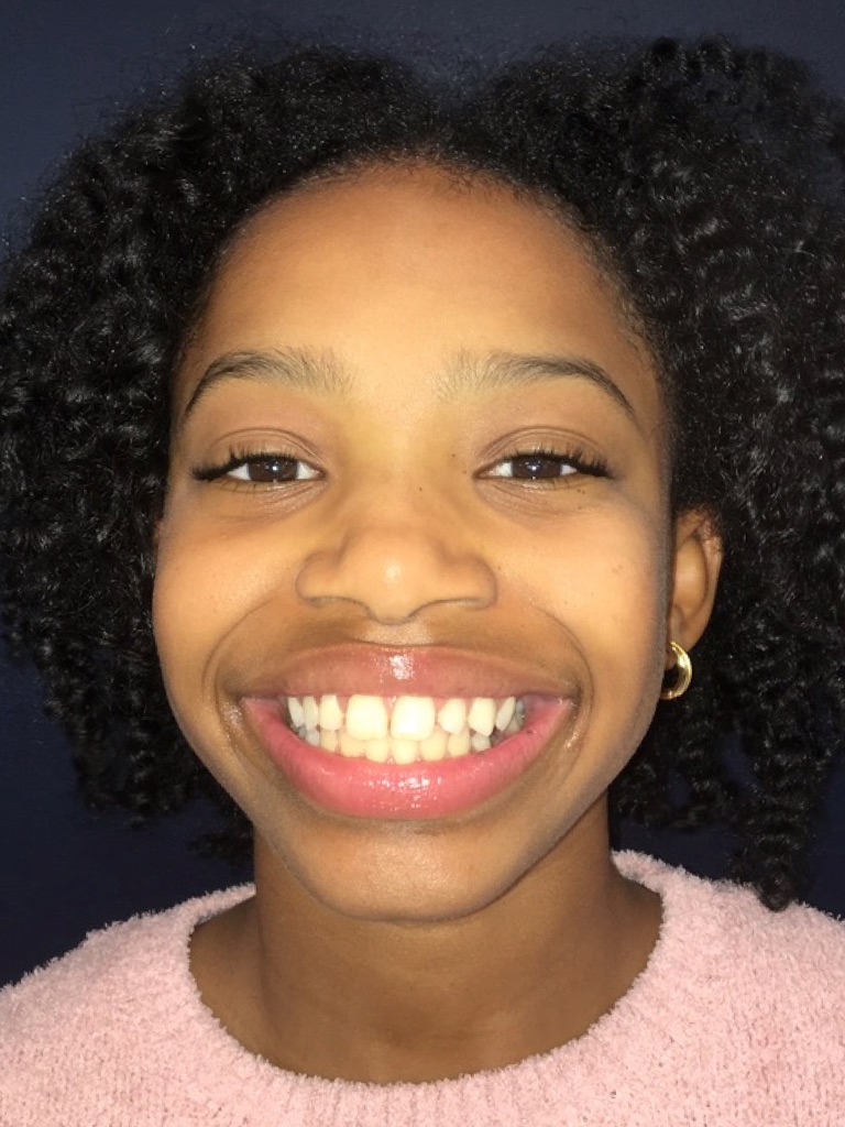 Case Four before smile photo