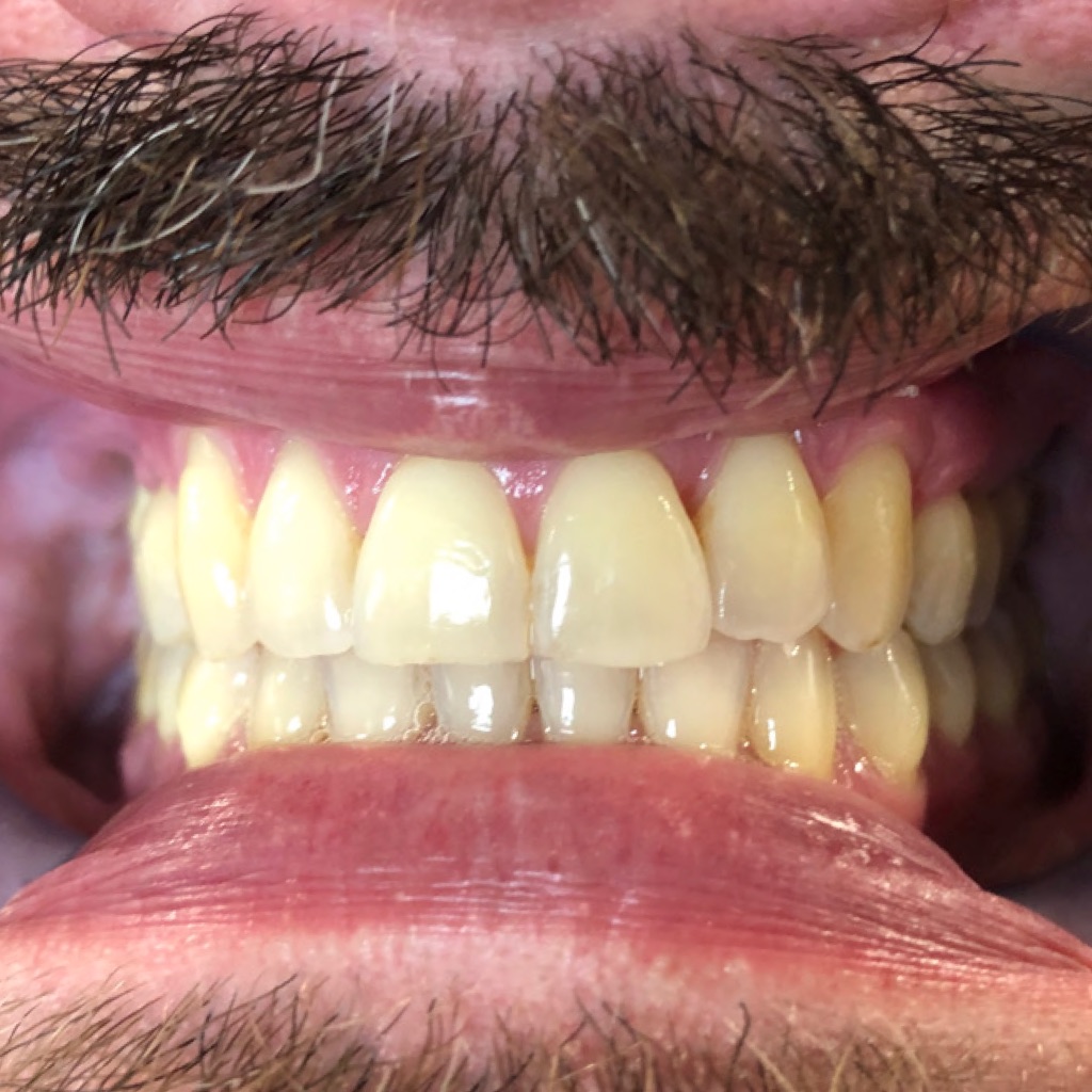 Case Five after teeth photo
