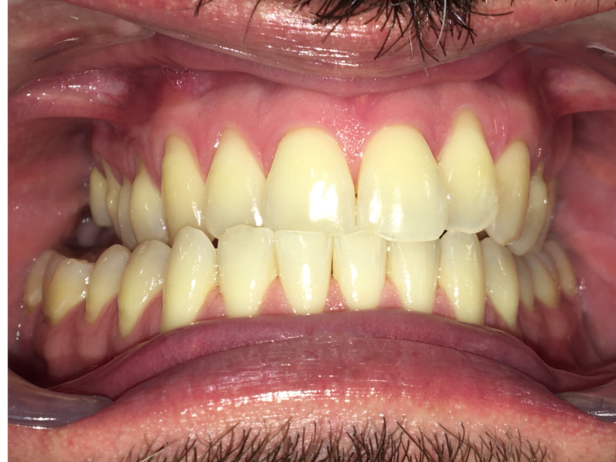 Case Five before teeth photo