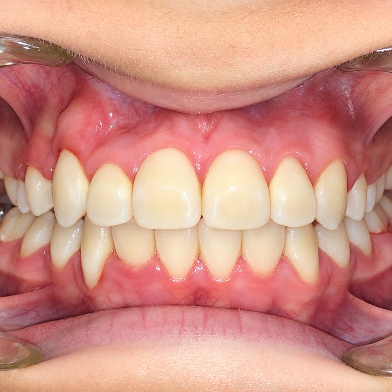 Case Six after teeth photo