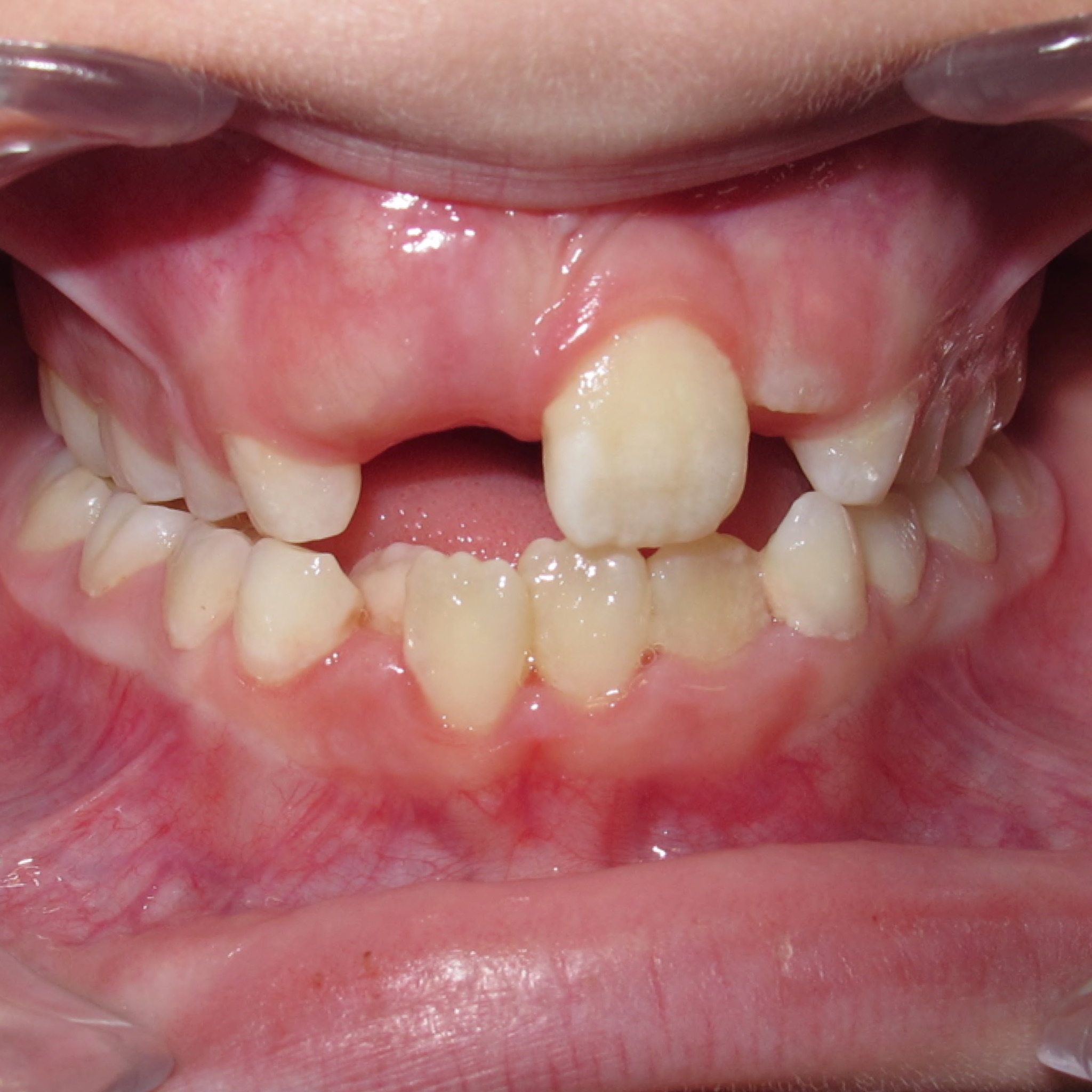 Case Six before teeth photo