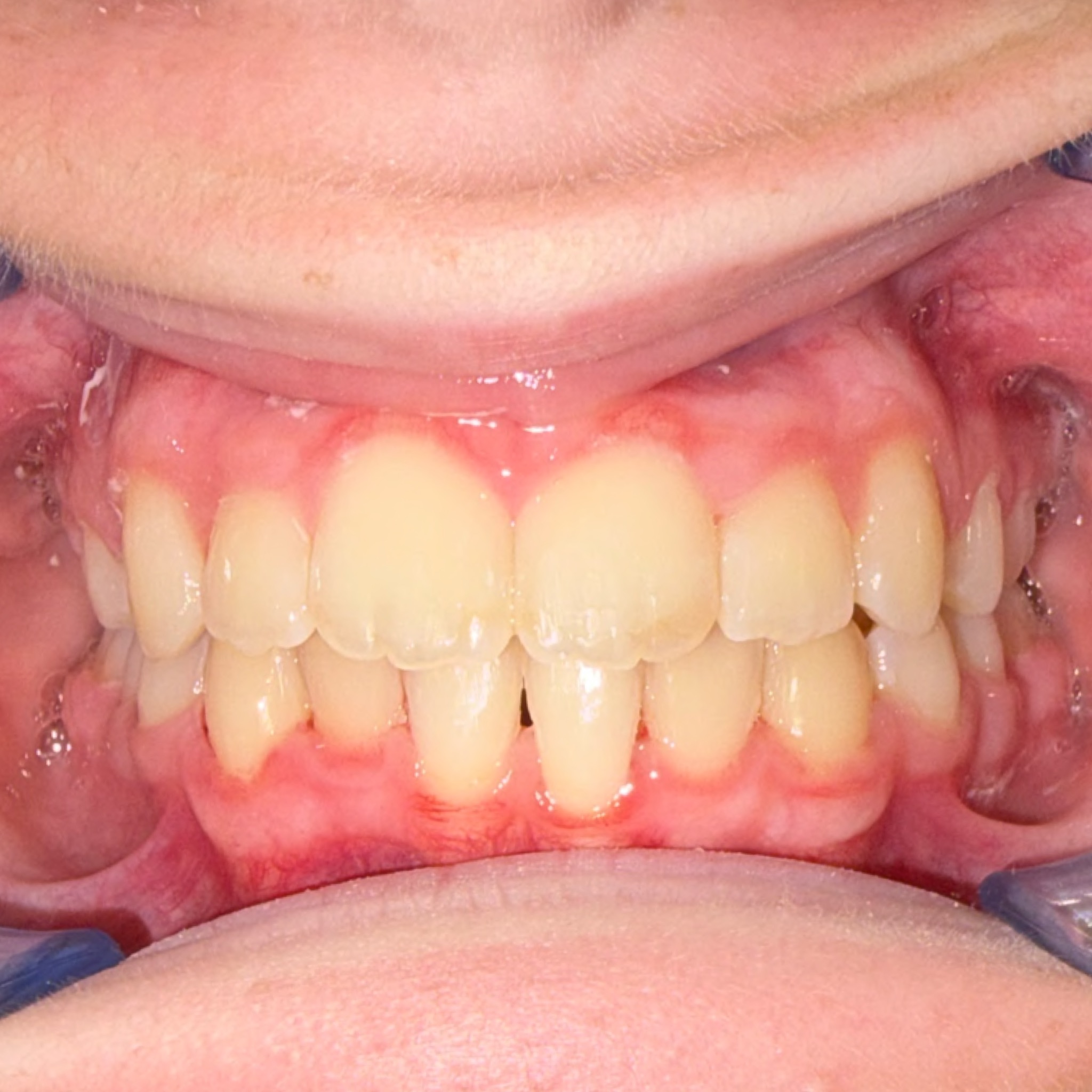 Case Seven after teeth photo