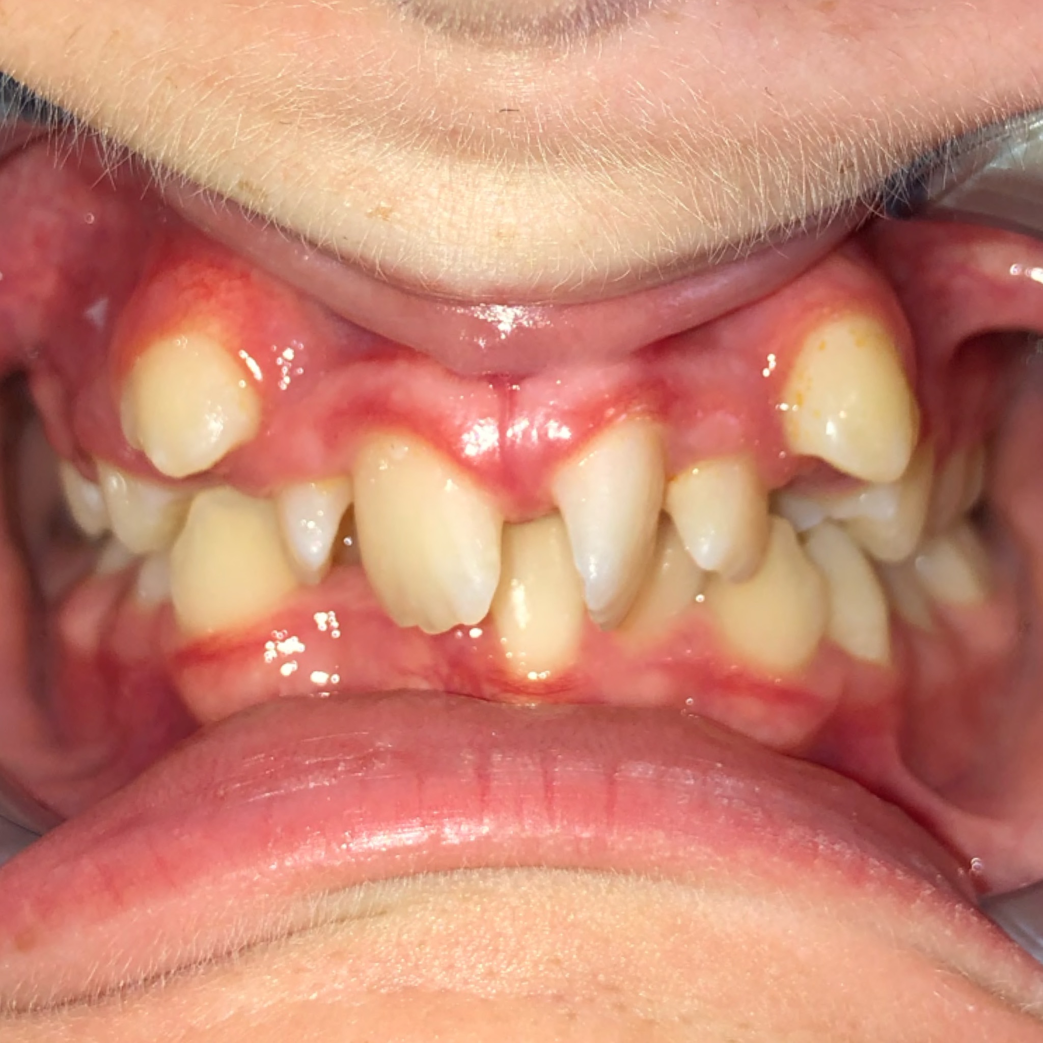 Case Seven before teeth photo