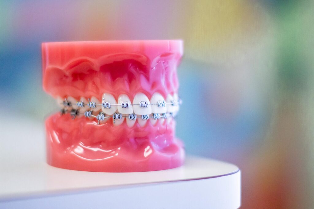 Metal braces on a teeth model